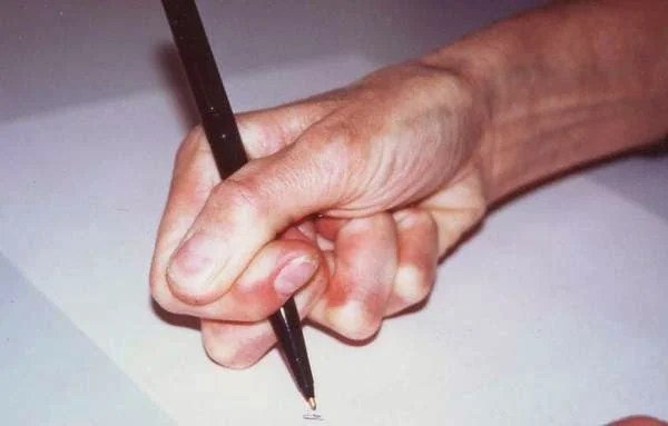 Writer's Cramp Treatment